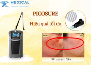 Ưu điểm máy trị nám bằng Laser Picosure