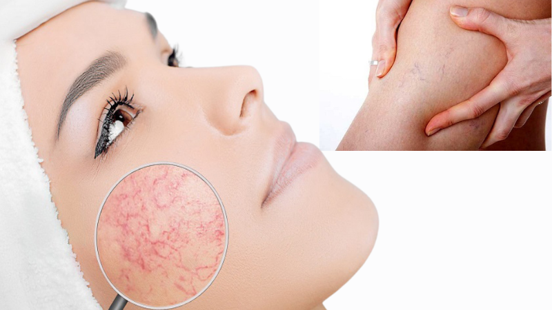 Laser xung dài Aileen điều trị bệnh giãn mao mạch