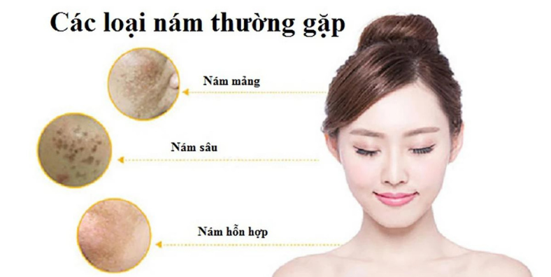 Laser nd YAG IRIS - Lựa chọn hàng đầu về điều trị bệnh lý sắc tố