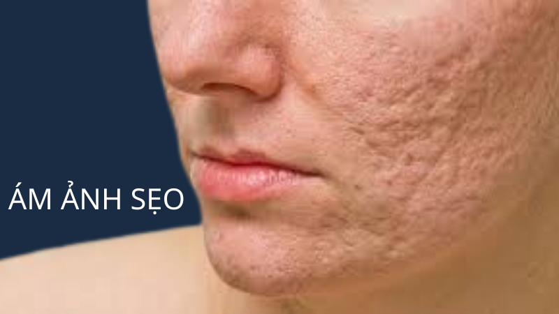 Laser Fractional CO2 điều trị sẹo, trẻ hóa da an toàn hiệu quả