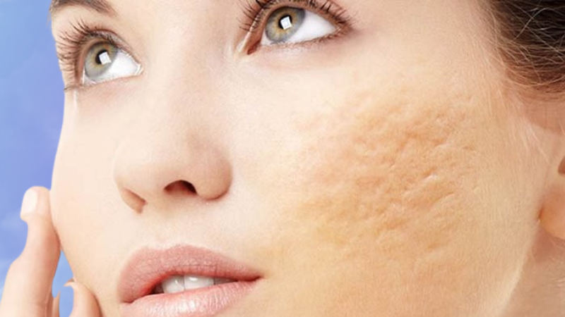 Laser fractional co2 Multixel điều trị sẹo an toàn hiệu quả