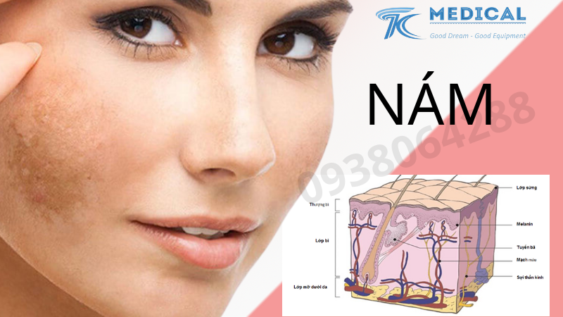 Phương pháp điều trị Nám bằng công nghệ Laser ND YAG