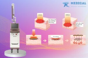 Máy Helios 3 sử dụng Laser Nd YAG Q-Switched
