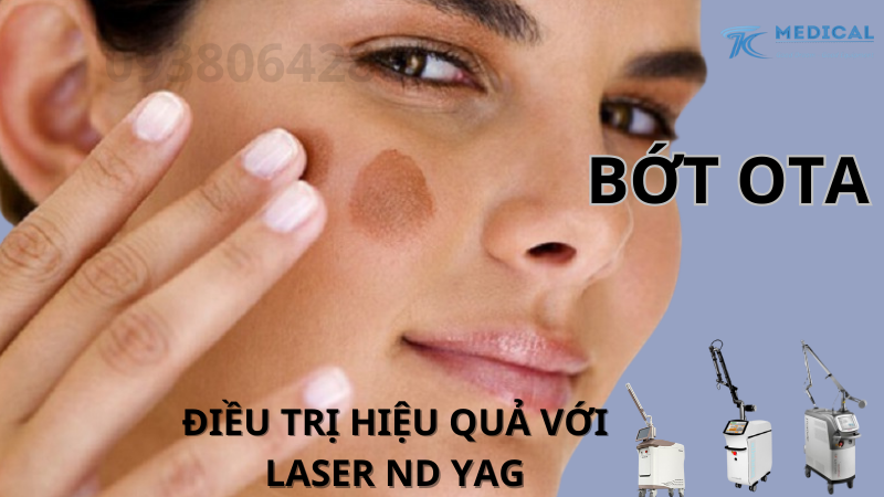 Laser: nd Yag điều trị bớt ota có thực sự hiệu quả?