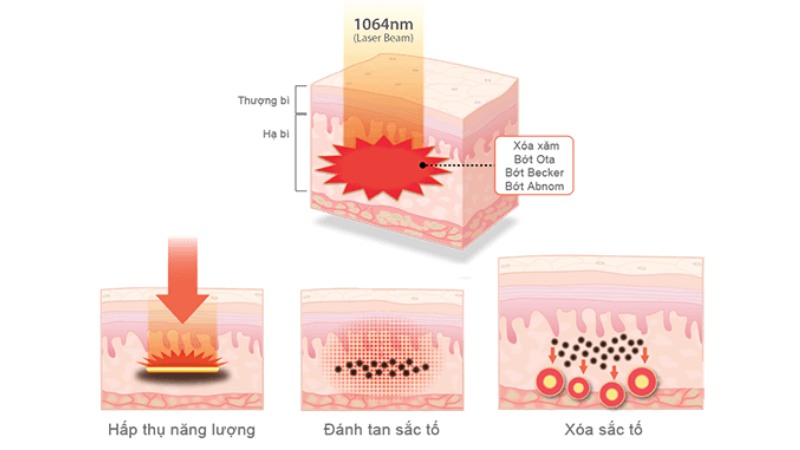 Laser: nd Yag điều trị bớt ota có thực sự hiệu quả?