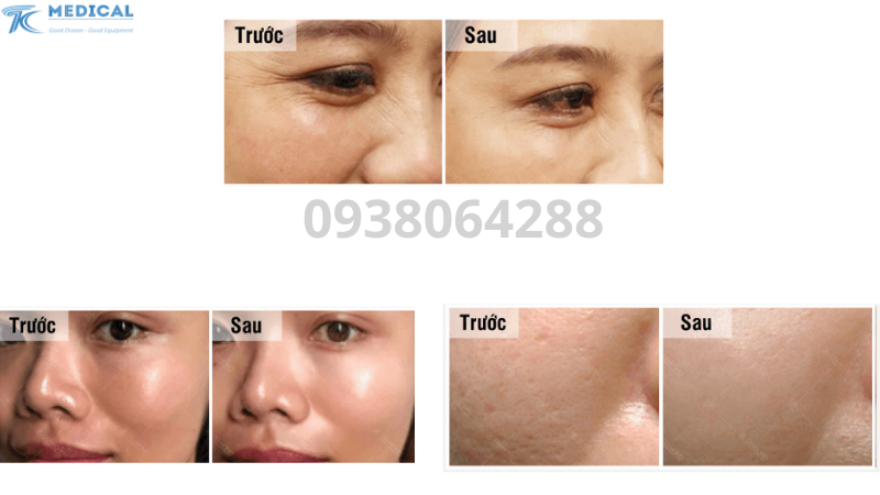 Laser Erbuim YAG Action II và ứng dụng trong da liễu