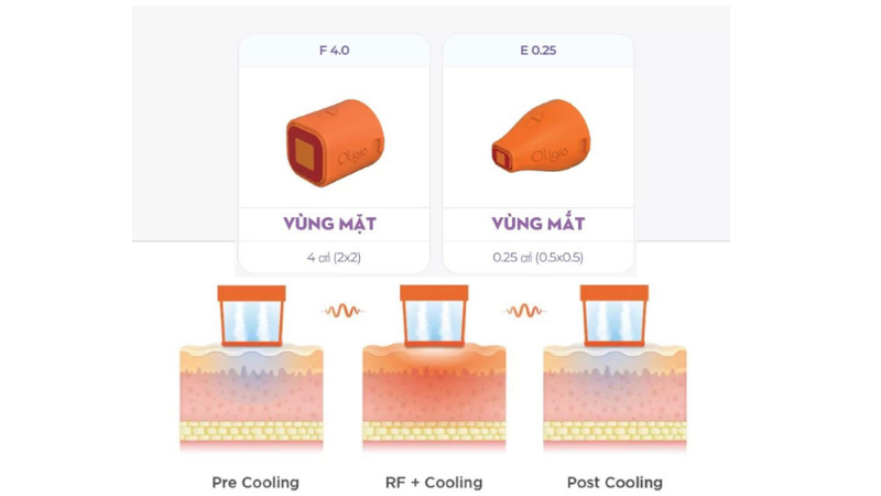 công nghệ Oligio RF nâng cơ, xóa nhăn hiệu quả tức thì