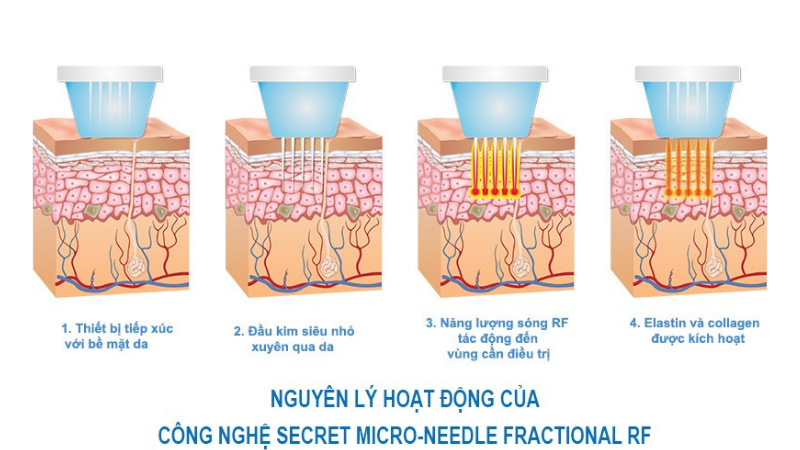 Secret RF - điều trị sẹo, trẻ hóa da cực đỉnh