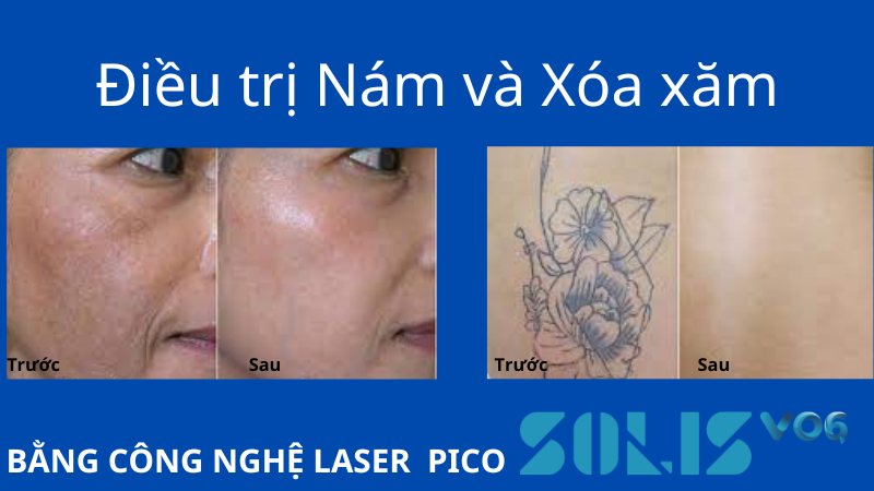 Laser Pico Solis VO6 điều trị nám, xóa xăm