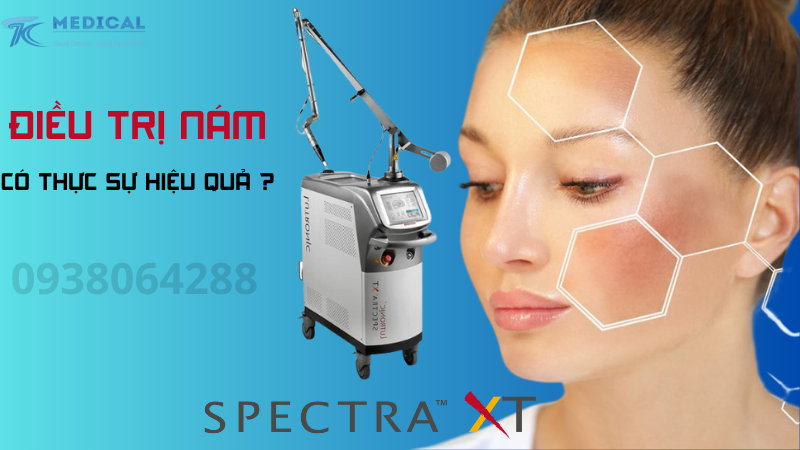 Nám điều trị bằng laser Spectra Xt có thực sự hiệu quả?