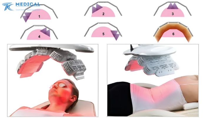 Tại sao nên lựa chọn quang trị liệu bằng đèn LED Healite II ở mức độ nhẹ?