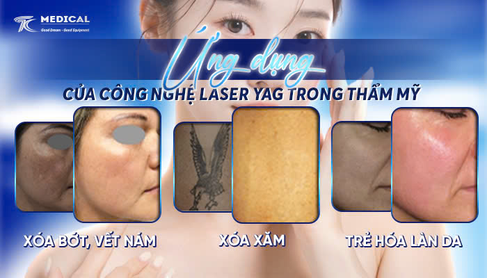 Ứng dụng của công nghệ laser YAG trong thẩm mỹ