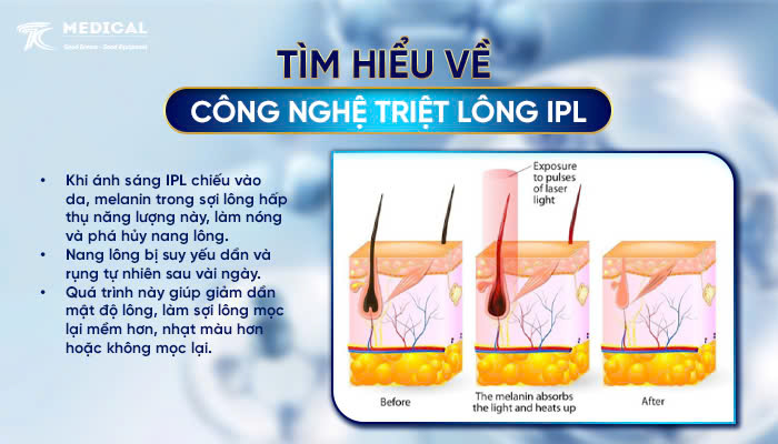 TÌM HIỂU VỀ CÔNG NGHỆ TRIỆT LÔNG IPL