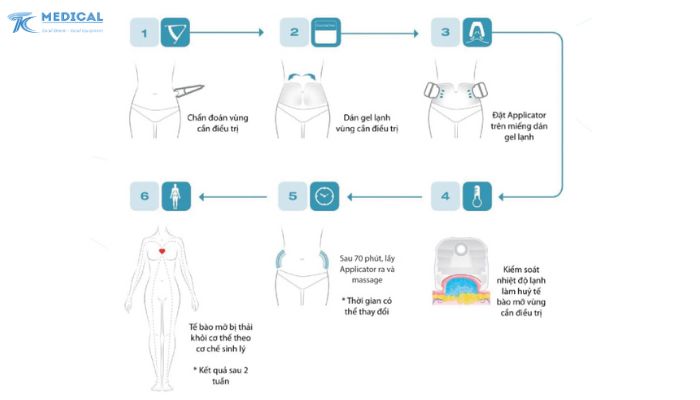 Quy trình giảm mỡ với máy Cooltech Define