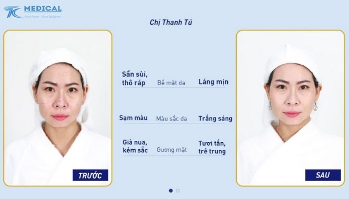 Ứng dụng Laser Picolo Premium trong điều trị