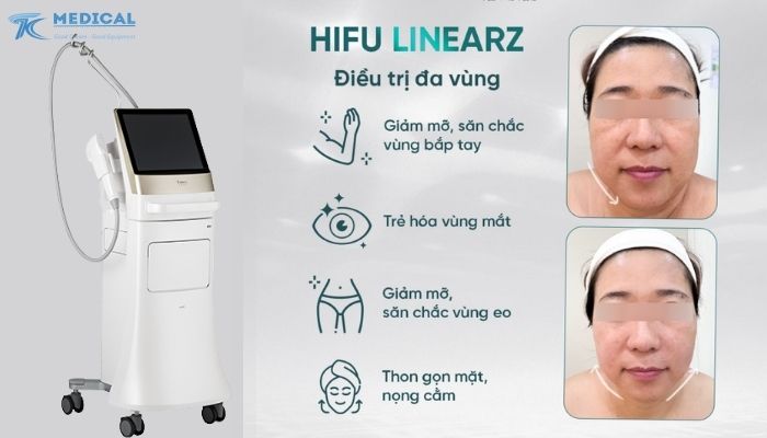 LinearZ mang lại hiệu quả tối ưu cho bác sĩ và bệnh nhân