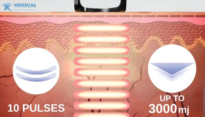 Hệ thống tay cầm chuyên biệt tăng hiệu quả điều trị