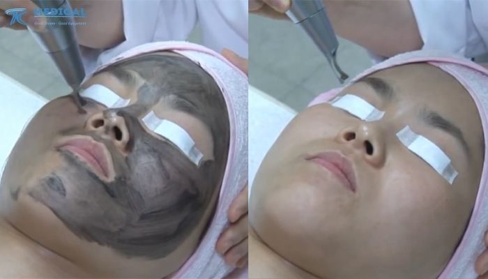 Hiệu quả máy Laser Lucas Plus mang lại