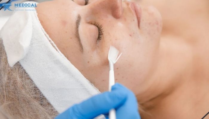 Peel da hóa học: Tái tạo bề mặt da hiệu quả