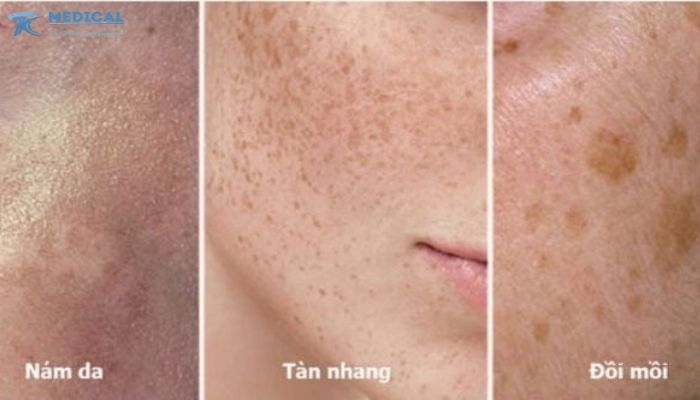Cơ chế hình thành và nguyên nhân chính gây đốm nâu trên da