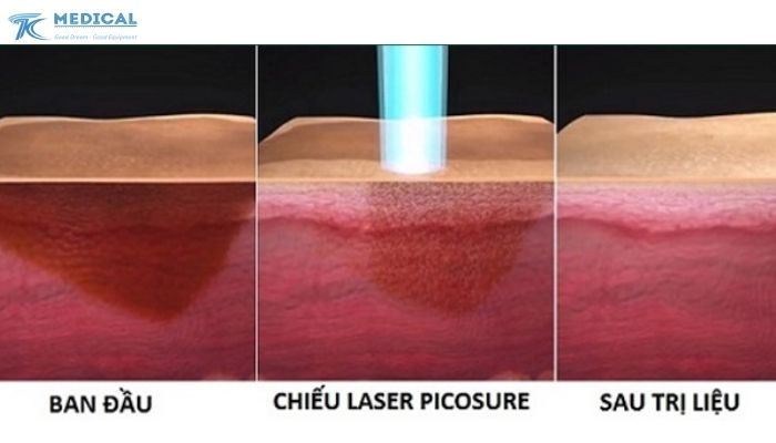 Laser xung ngắn là gì? Cơ chế tác động sinh học