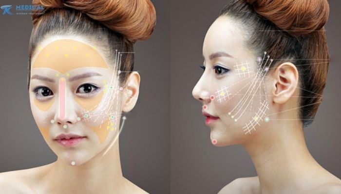 Các phương pháp nâng cơ phổ biến hiện nay