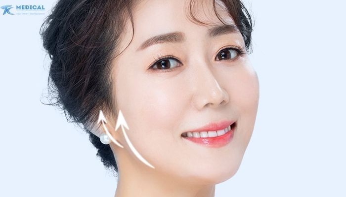 Ưu nhược điểm của công nghệ nâng cơ trẻ hóa