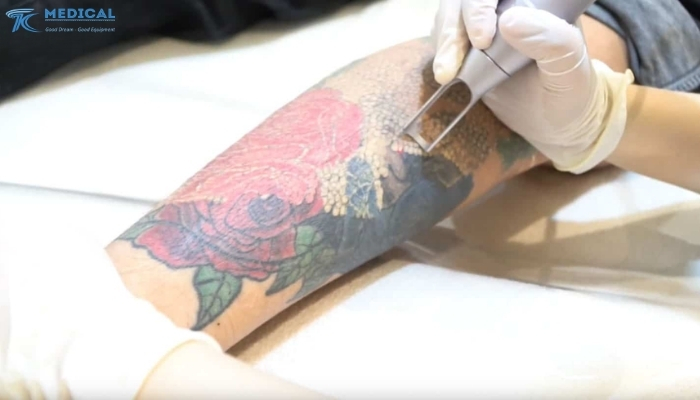 Xóa xăm màu bằng laser có hiệu quả không?