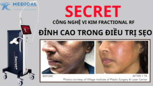 Công nghệ vi kim Fractional RF Secret trong điều trị sẹo