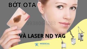 Laser: nd Yag điều trị bớt ota có thực sự hiệu quả?