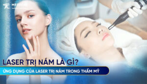 Tìm hiểu về Laser trị nám