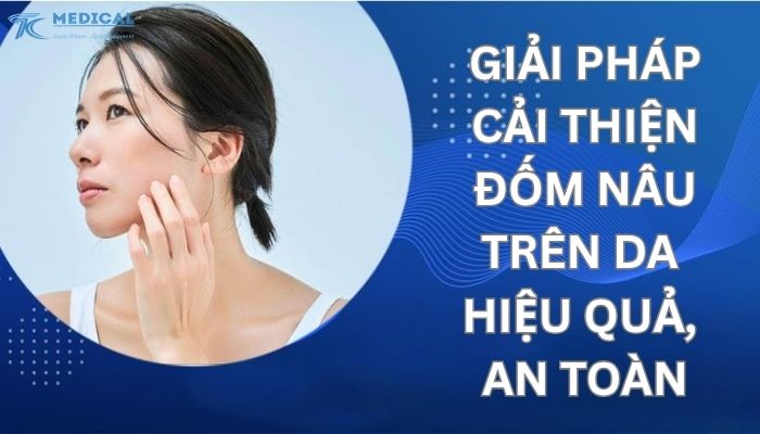NGUYÊN NHÂN VÀ GIẢI PHÁP CẢI THIỆN ĐỐM NÂU TRÊN DA HIỆU QUẢ, AN TOÀN